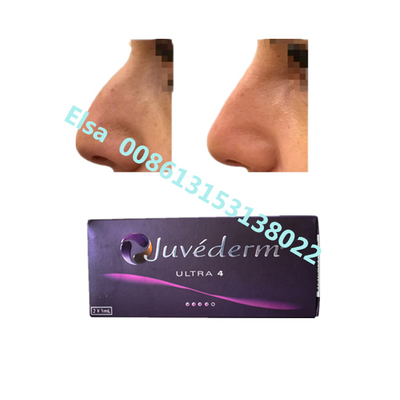 Juvederm Sodium Ultra4 Volume Filler Dermique Pour Augmentation des lèvres et du menton