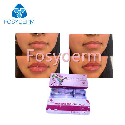 Remplisseur cutané de Fosyderm d'injection d'acide hyaluronique pour la croix de la lèvre 2ml liée