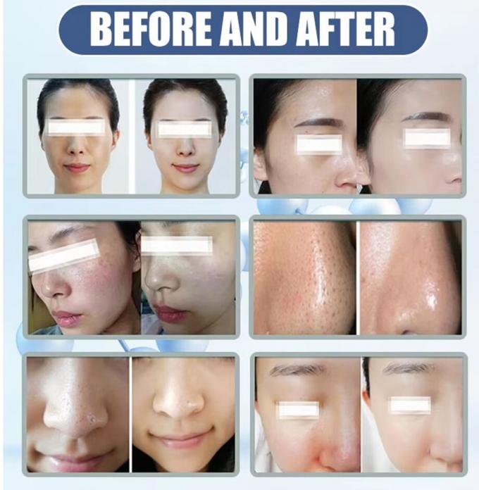 Meilleur soins du visage à domicile Microdermabrasion Machine 2024 équipement de beauté 6