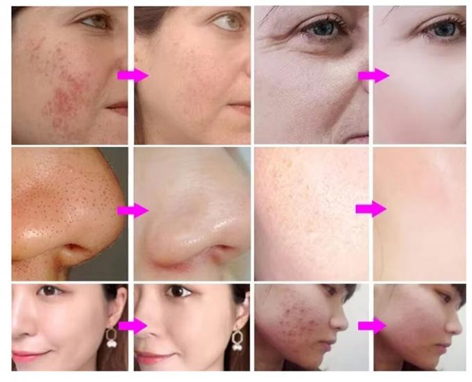 Hydra Peeling Hydra Facial Petite bulle d'eau Hydro Aqua Facial H2O2 Hydra Machine 2
