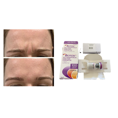 Injection anti-vieillissement de  de toxine botulinum blanche d'Allergan