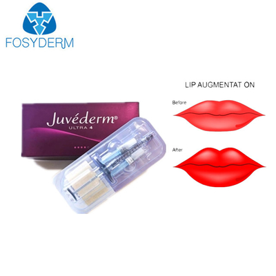 Juvederm remplisseur cutané d'ultra 3 acides hyaluroniques pour des lèvres de visage