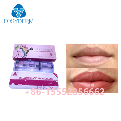 acide hyaluronique cutané de remplisseur de 2ml Fosyderm pour l'amélioration de lèvres