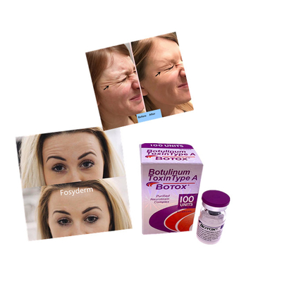 Injection botulinum de poudre de remplisseur d'anti de ride unités cutanées d'Allergan  100