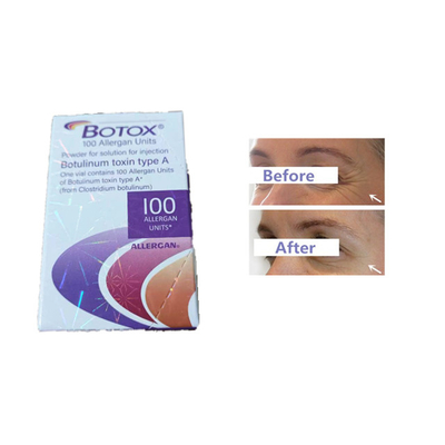 Rides botulinum de front d'unités de la toxine 100 d'injection d'Allergan