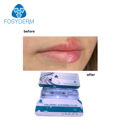 Injection cutanée d'acide hyaluronique des remplisseurs 1ml de lèvre de Fosyderm pour l'amélioration de lèvre