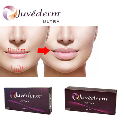 Juvederm Ultra3 Acide hyaluronique pour les lèvres Gel pour injection cutanée pré-rempli