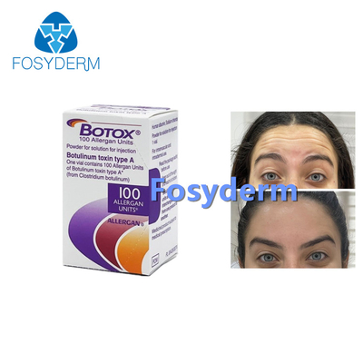 100Units Allergan Toxion botulinum pour enlèvent le type facial A de  de rides