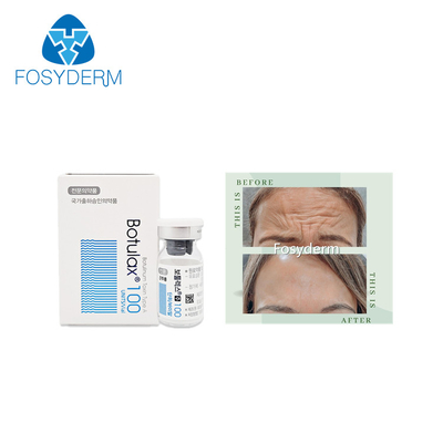 100 unités dactylographient une toxine botulinum Allergan que l'anti massage facial ride l'injection de  Botulax