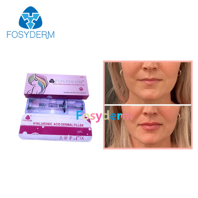 Ligne cutanée de Derm d'injection d'amélioration de lèvre d'acide hyaluronique de remplisseurs de lèvre de Fosyderm 2ml