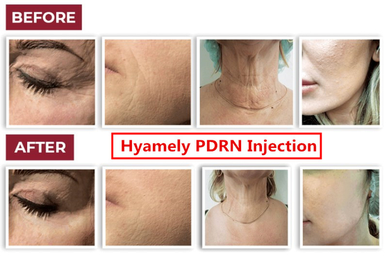 Sérum du propulseur PDRN de peau de Regation de cellules de Hyamely pour le cou blanchissant l'injection faciale
