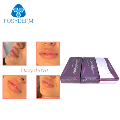 Les lèvres améliorent le remplissage cutané 2*1ml Juvederm Injection d'acide hyaluronique