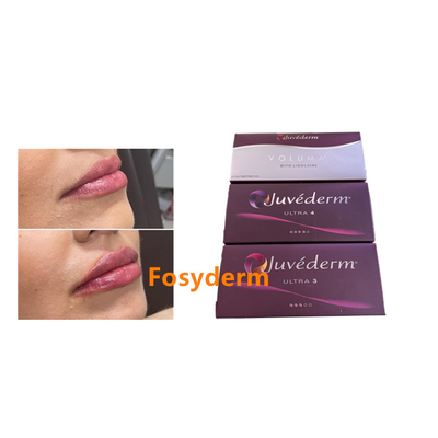 Juvederm 2*1ml Acide hyaluronique Remplisseur cutané Augmentation des lèvres Augmentation du menton