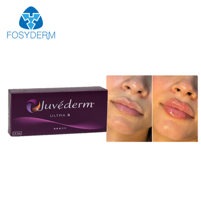 Juvederm Fillers pour lèvres cutanés 2*1 ml d'acide hyaluronique par injection croisée