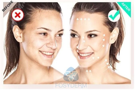 Filorga  135ha 5*3ml Mesothérapie par injection faciale pour améliorer la qualité de la peau