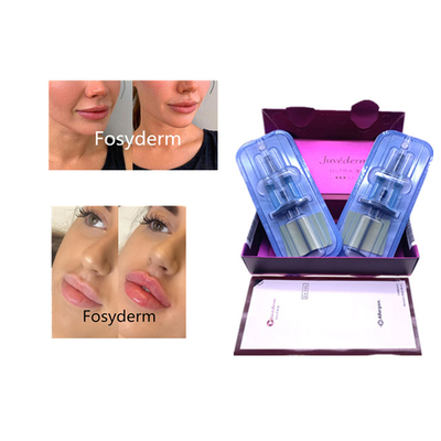 Juvederm Acide hyaluronique Remplisseur cutané anti-âge 2*1ml Remplisseur facial