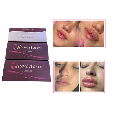 Injections de soins de la peau Plumper pour les lèvres Juvederm Acide hyaluronique Filler cutané pour le visage