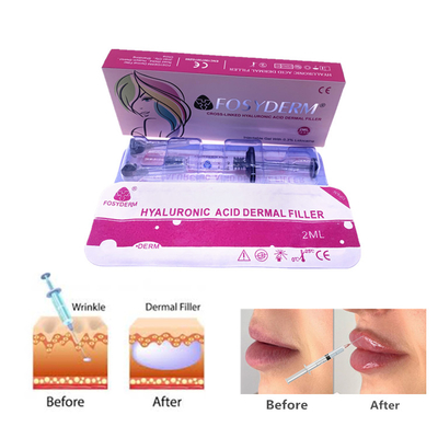 Fosyderm 2 ml Gel d'acide hyaluronique injections de remplissage cutané pour soins de la peau du visage et du nez