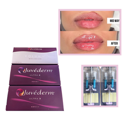 Juvederm Voluma Acide hyaluronique pour les lèvres