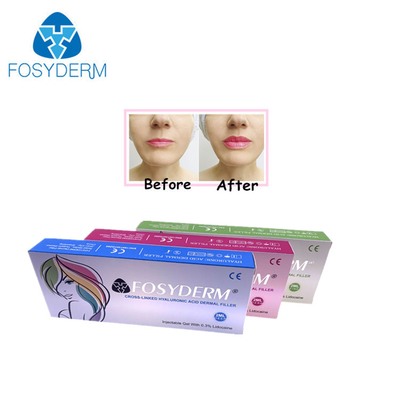 Gel de remplissage d'acide hyaluronique 1 ml pour la réduction des rides et la mise en forme du visage
