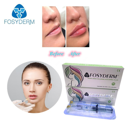 Gel de remplissage d'acide hyaluronique 1 ml pour la réduction des rides et la mise en forme du visage