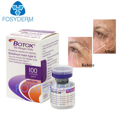 Type A 100 Unités Allergène Toxine Botulinique Remplisseur Dermique Acide Hyaluronique