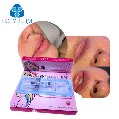 Produit de comblement dermique à l'acide hyaluronique pour le rajeunissement du visage, le menton, les joues, les lèvres, le corps, les fesses