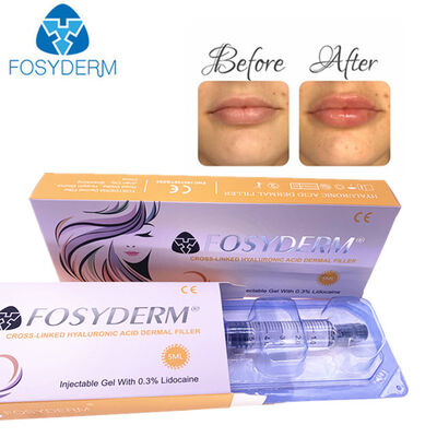 Acide hyaluronique dermal filler anti-rides lifting facial 1ml 2ml