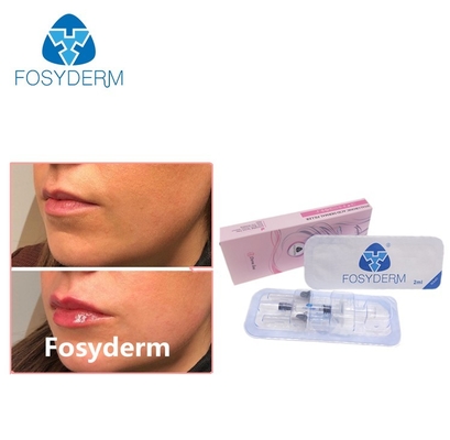 Gélifiez Fosyderm 2ml croisent le remplisseur cutané lié d'acide hyaluronique pour l'amélioration de lèvre