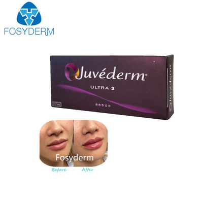 Juvederm ultra 3 1 ml * 2 injections cutanées de lèvre de remplisseur d'acide hyaluronique