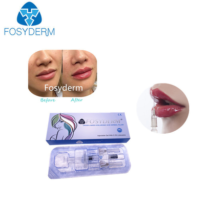 injection d'amélioration de lèvre de Derm de remplisseurs de lèvre de l'acide hyaluronique 1ml pour des femmes