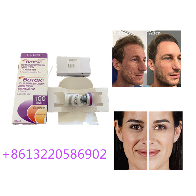 L'injection anti-vieillissement 100units d'Allergan  dactylographient une anti ride