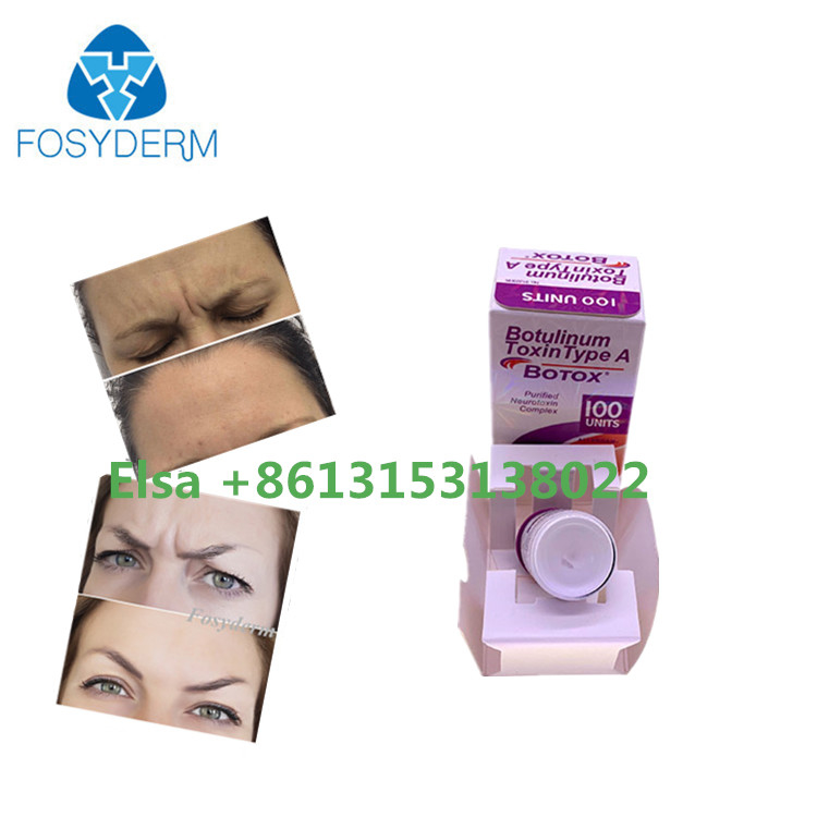 Type botulinum de toxine visage de ride de remplisseur cutané de s un anti injectable
