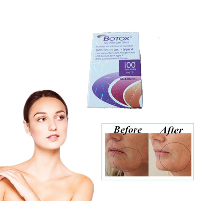 Allergan  100 Unités Types Injection de Toxine Botulique Anti Rides