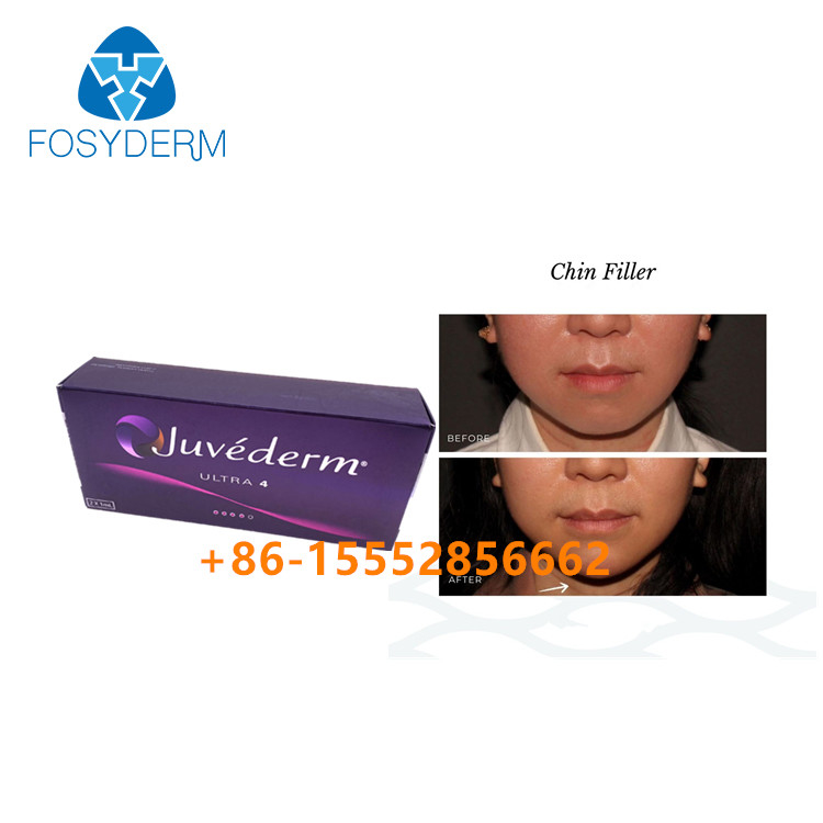 Remplisseur Juvederm Ultra4 2ml cutané de Chin Augmentation Hyaluronic Acid Facial