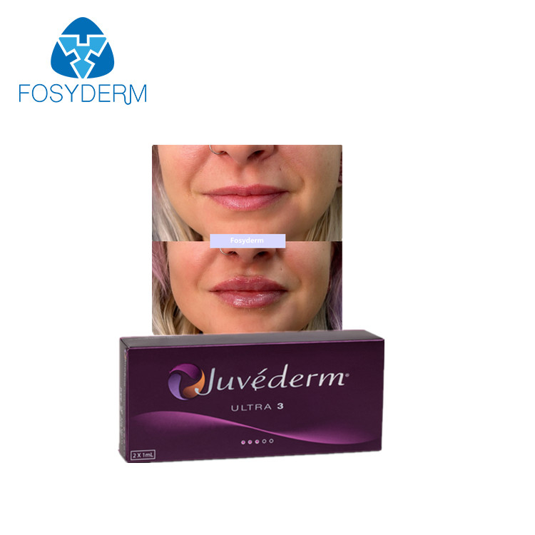 Les remplisseurs cutanés de lèvre de Juvederm Ultra3 croisent l'acide hyaluronique lié d'amélioration de lèvre