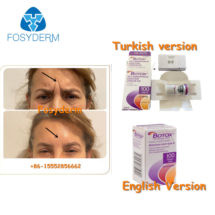 100Units Allergan Toxion botulinum pour enlèvent le type facial A de  de rides