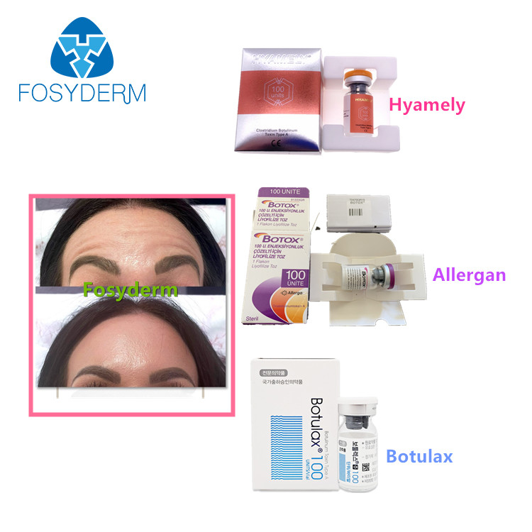 100 unités dactylographient une toxine botulinum Allergan que l'anti massage facial ride l'injection de  Botulax