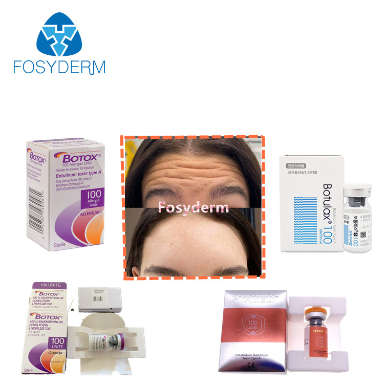 rides  Allergan d'injection botulinum de toxine de 100units TypeA anti