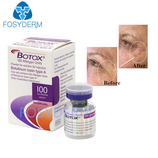 Type A 100 Unités Allergène Toxine Botulinique Remplisseur Dermique Acide Hyaluronique
