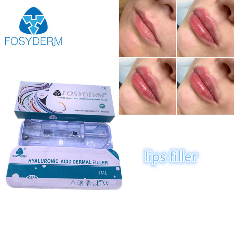 Remplisseurs remplissants 1ml de lèvre d'acide hyaluronique de Fosyderm Fosyderm d'injection de visage