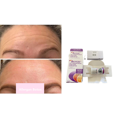 Injection botulinum de poudre de toxine du retrait 100units Allergan  de ride