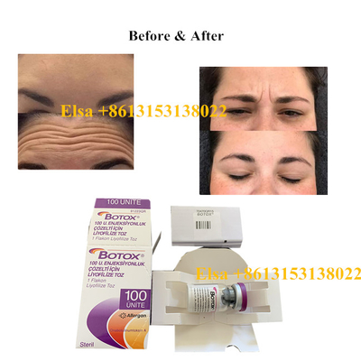 Type botulinum de toxine d'Allergan d'injection un 100units anti-vieillissement