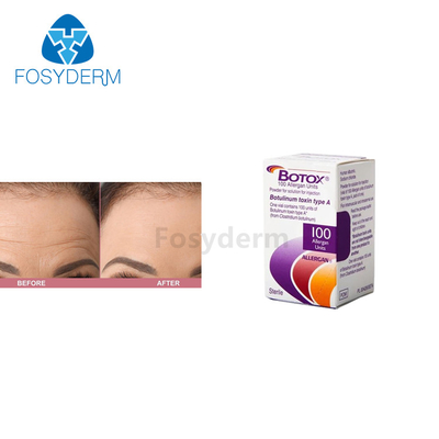 Injection botulinum de toxine d'Allergan  de 100 unités pour d'anti rides