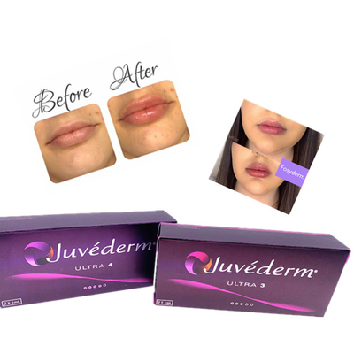 Ce cutané 2ml anti-vieillissement de remplisseur de lèvre de Juvederm d'injection de gel d'acide hyaluronique