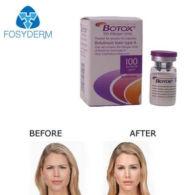 Allergan Botox Injection 100 unités pour éliminer les rides