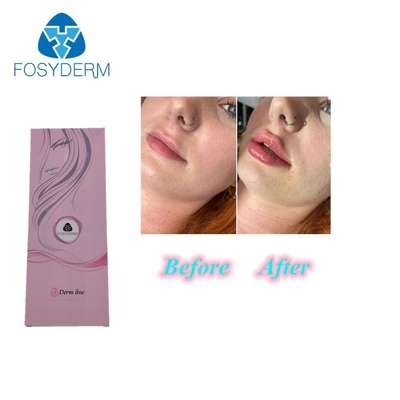 injection d'acide hyaluronique de remplisseur de lèvre du lidocaïne 1ml 0,3%