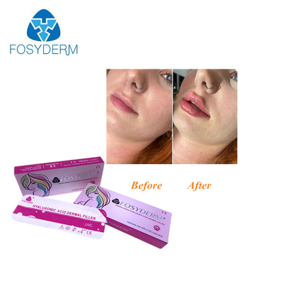 Remplisseur injectable cutané d'acide hyaluronique pour le visage de nez